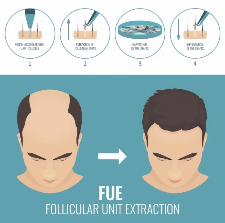 FUE saç Implant mikro Motor sa - Hair Care Nutrition incelemesi ve fiyatı